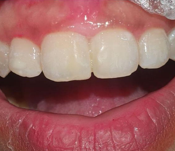 Teeth Whitening Treatment New Town