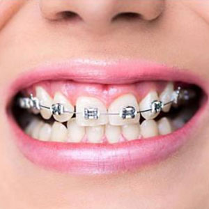 Teeth Whitening Treatment New Town