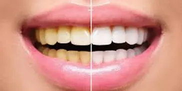 Teeth Whitening Treatment New Town