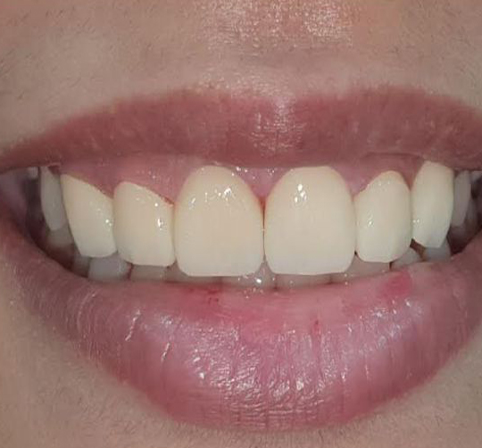 Teeth Whitening Treatment New Town